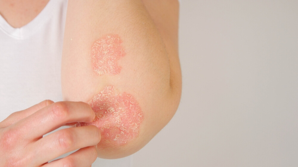 Skin Lesions