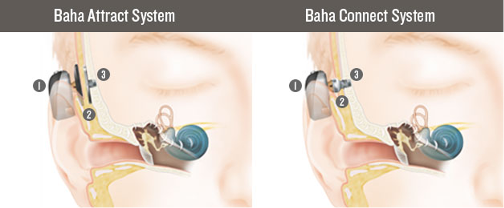 BAHA Processor