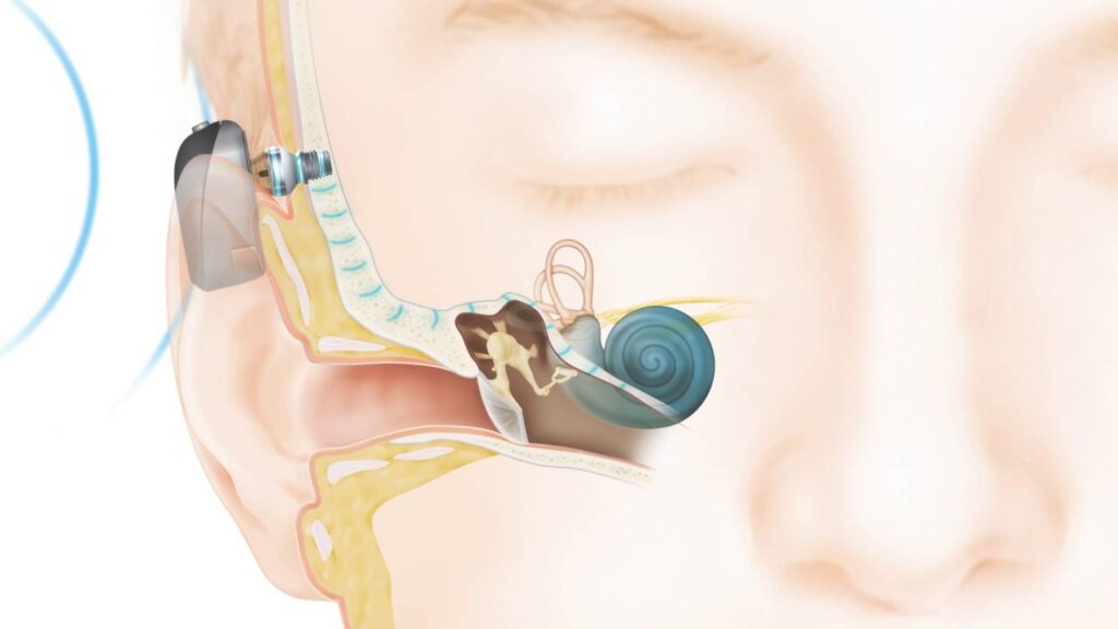 Bone Conducting Implant