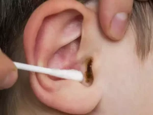 Ear Wax