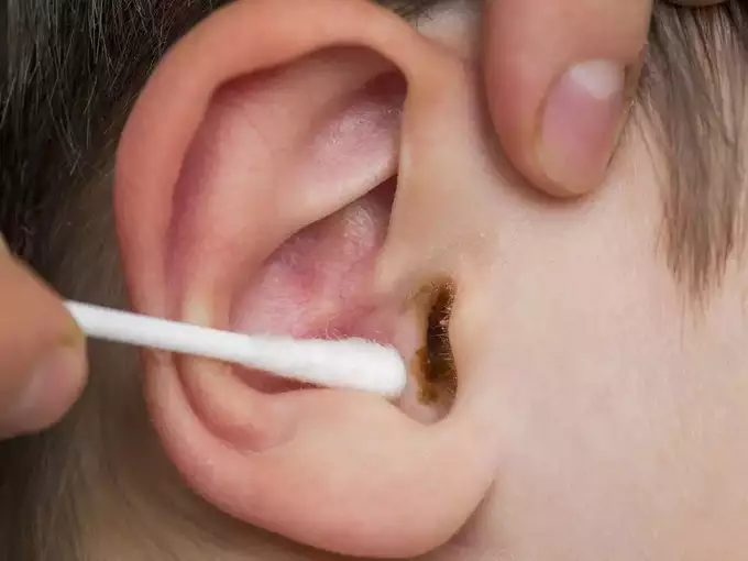 Ear Wax