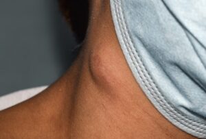 Lymph Node Swelling