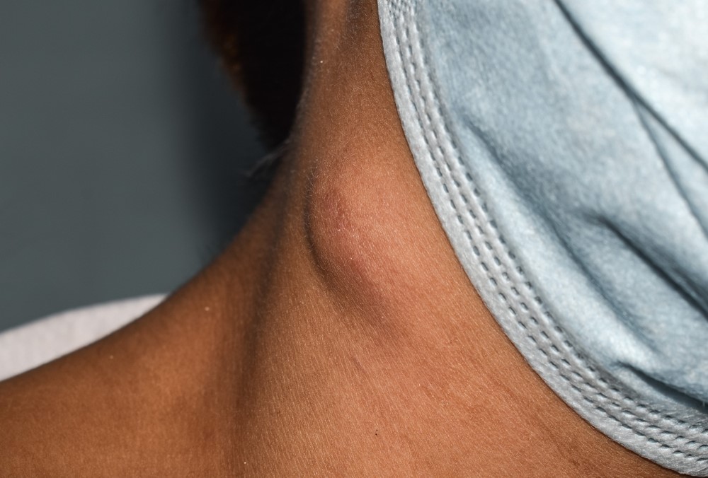 Read more about the article Lymph Node Swellings