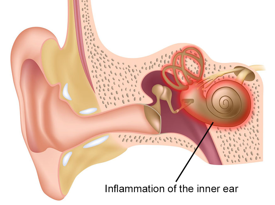 Read more about the article Labyrinthitis