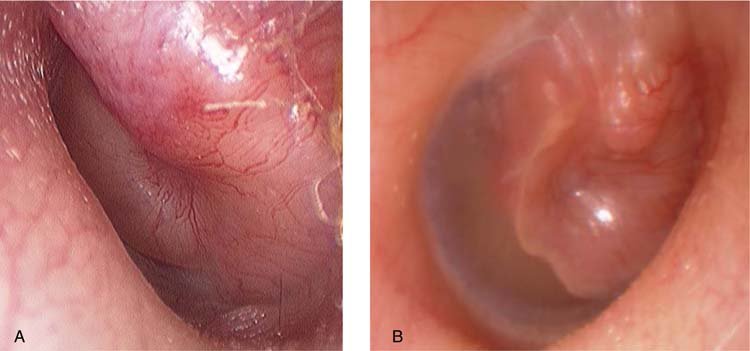 Read more about the article Middle Ear Tumors