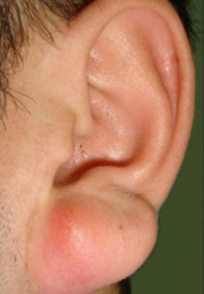Sebaceous Cysts