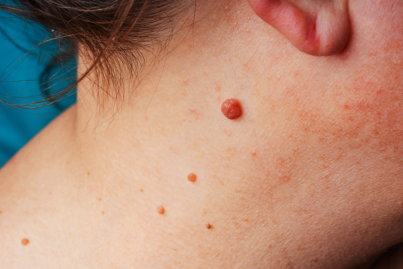 Read more about the article Skin Lesions