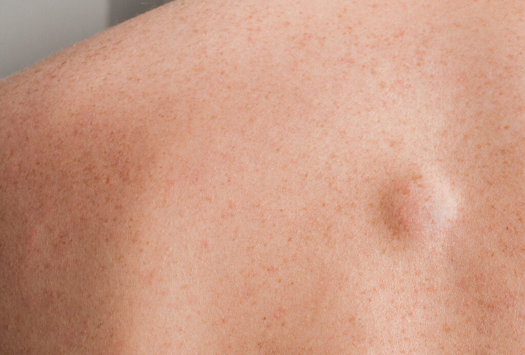 Lipoma