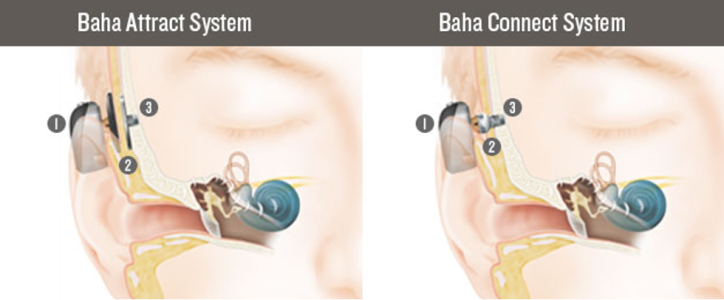 BAHA processor