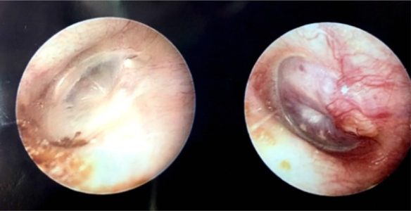 Glomus Tumors