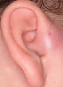 Pre-auricular sinuses are small holes or cysts that develop above the ear canal, in front of the ear. They are also known as pre-auricular pits, cysts or fissures.