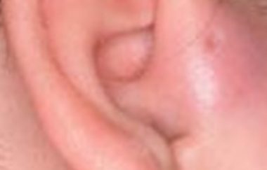 Pre-auricular sinuses are small holes or cysts that develop above the ear canal, in front of the ear. They are also known as pre-auricular pits, cysts or fissures.