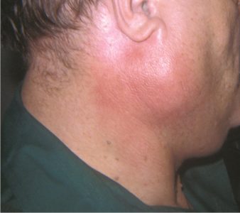 submandibular gland swelling home remedies