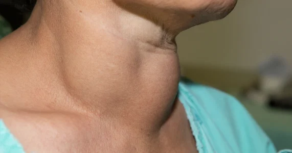 Thyroid swellings