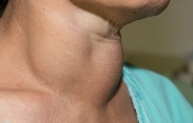Thyroid swellings