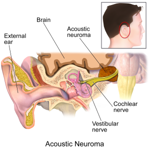 Vestibular Schwannoma
